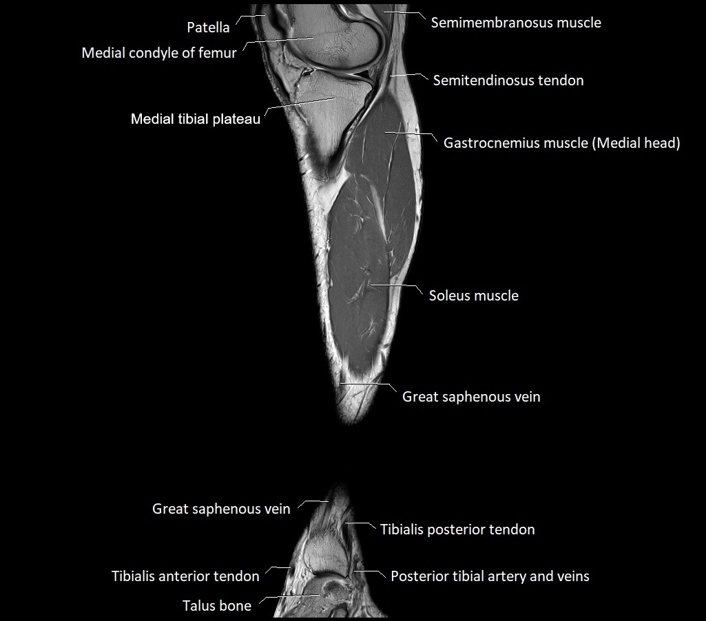 Lower leg sagittal anatomy 3T MRI image 23.webp